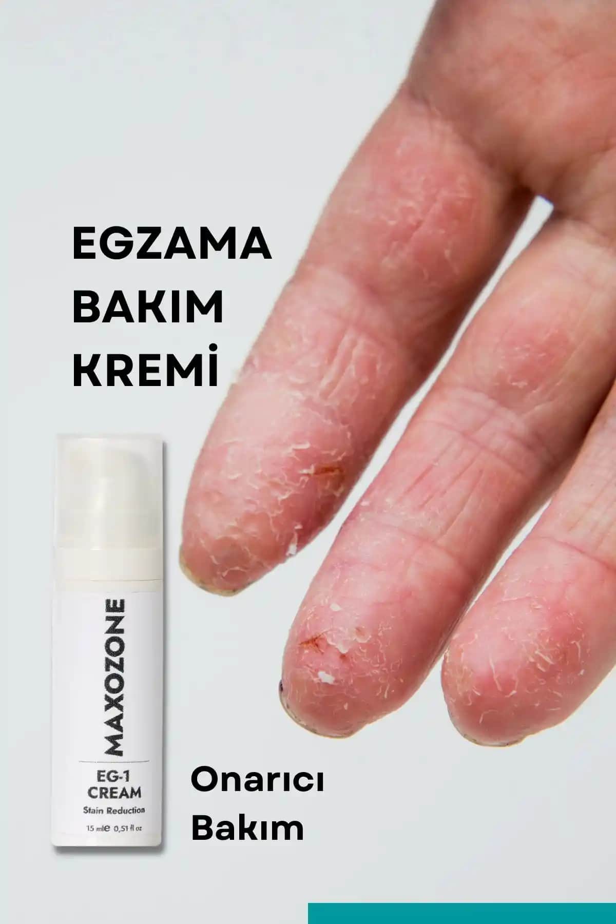 Egzama El Kremi Seçimi ve Bakım İpuçları Cilt Sağlığını Koruma Rehberi