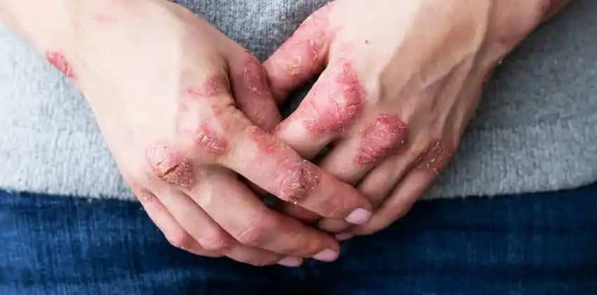 Egzama Hastalığı ve Doğru Kozmetik Seçimleriyle Cilt Sağlığını Koruma Rehberi