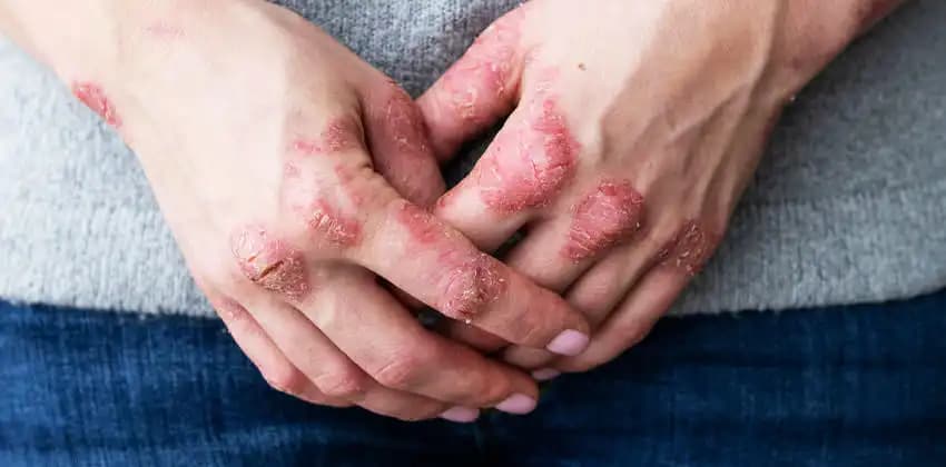 Egzama Hastalığı ve Doğru Kozmetik Seçimleriyle Cilt Sağlığını Koruma Rehberi