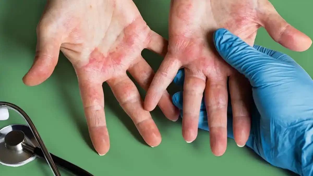 Egzama Nedenleri ve Bilinçli Yaklaşımlar: Cilt Sağlığını Koruma Rehberi