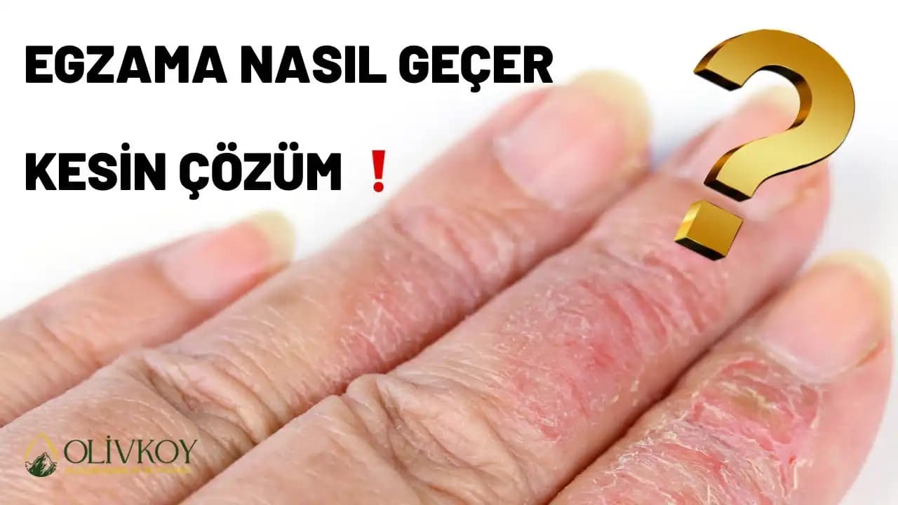 Egzama Tedavisinde Zeytinyağının Rolü ve Doğal Cilt Bakım Yöntemleri