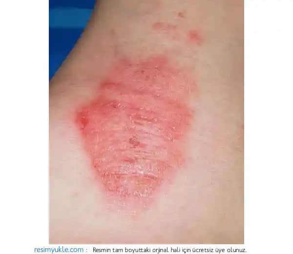 Egzama Türleri ve Kozmetik Bakım İpuçları: Cilt Sağlığını Koruma Yöntemleri