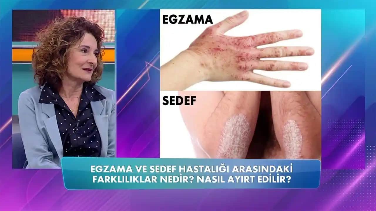Egzama ve Sedef Hastalığının Ayırıcı Tanısı: Klinik Özellikler ve Tanı Yöntemleri