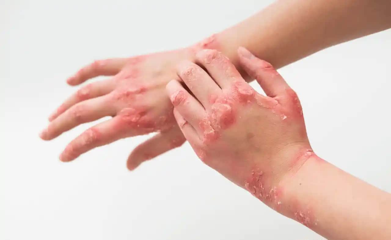 Egzama ve Stresin Elde Oluşan Kabarcıklara Etkisi: Cilt Sağlığını Koruma Yolları ve Bilinçli Bakım