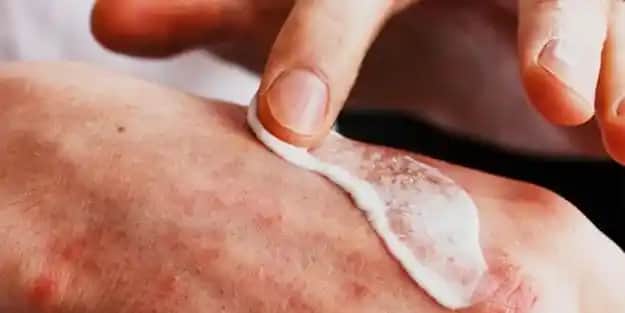 Egzama Yaraları ve Doğru Bakım Yöntemleri: Cilt Sağlığını Korumak İçin İpuçları