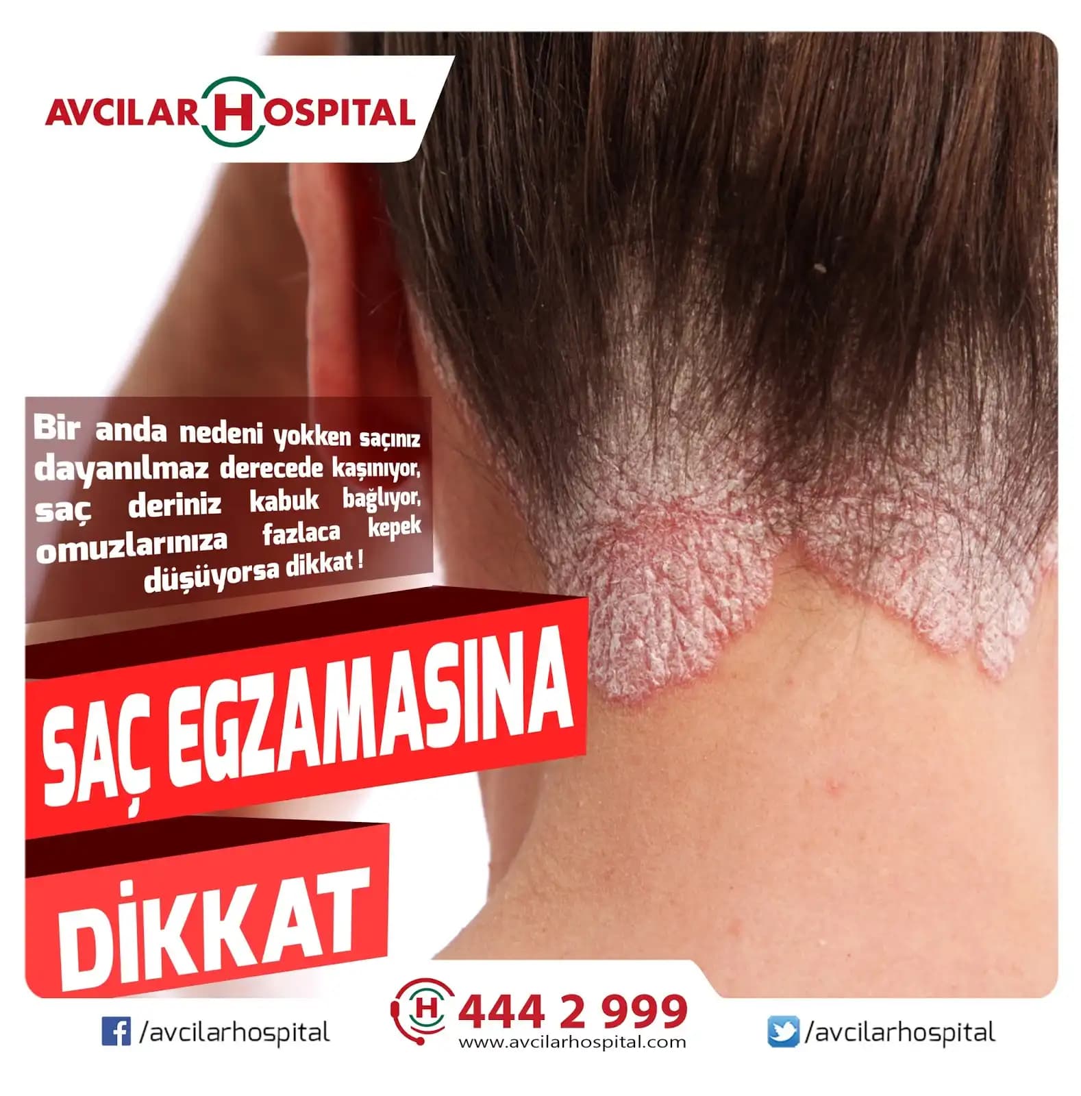 Egzamalı Saç Nedir, Belirtileri ve Doğru Bakım Yöntemleri Hakkında Kapsamlı Bilgi