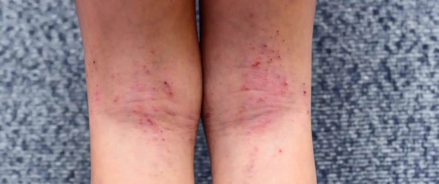 Egzema Belirtileri ve Cilt Sağlığını Koruma Yöntemleri Hakkında Bilgiler