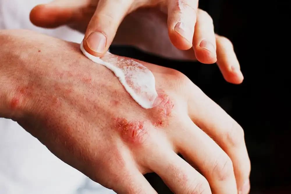 El Egzaması ve Cilt Sağlığını Koruma Yöntemleri: Belirtiler, Riskler ve Bakım Tavsiyeleri