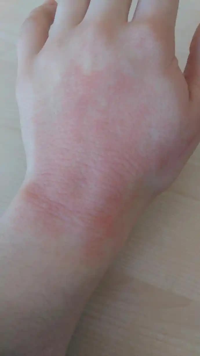 El Üstü Kızarıklıklarının Nedenleri ve Koruyucu Önlemler Hakkında Detaylı Bilgi