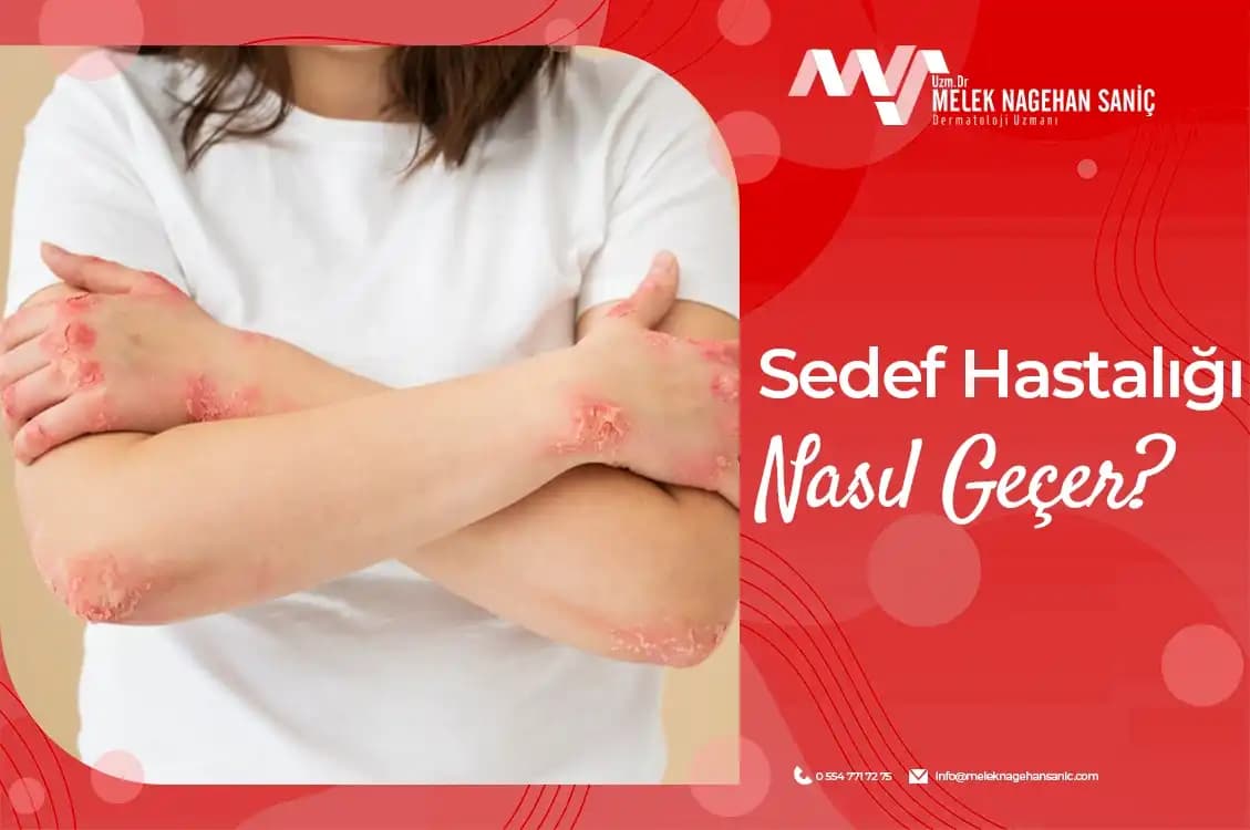 El Üzerindeki Sedef Lekeleri Nasıl Geçer: Nedenleri ve Etkili Çözüm Yolları