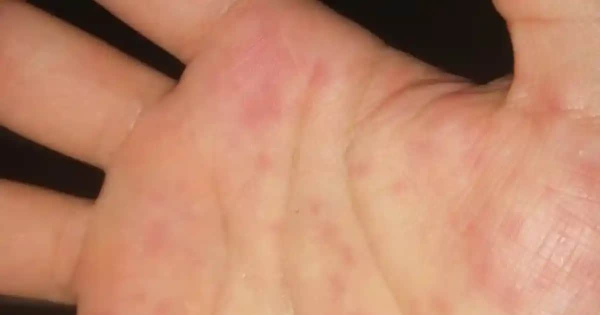 Elde Çıkan Kırmızı Nokta Nedir, Nedenleri ve Tedavi Yöntemleri Hakkında Bilgiler