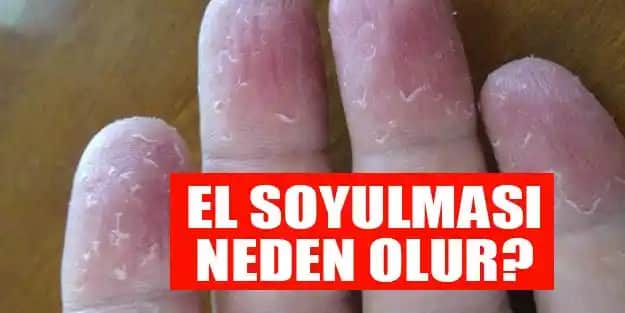 Elde Deri Soyulması Nasıl Geçer ve Sağlıklı Eller İçin İpuçları