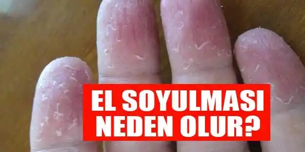 Elde Deri Soyulması Nasıl Geçer ve Sağlıklı Eller İçin İpuçları