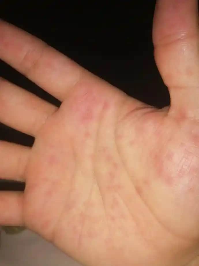 Elde Görülen Küçük Kırmızı Noktalar: Kozmetik ve Sağlık Açısından Detaylı İnceleme