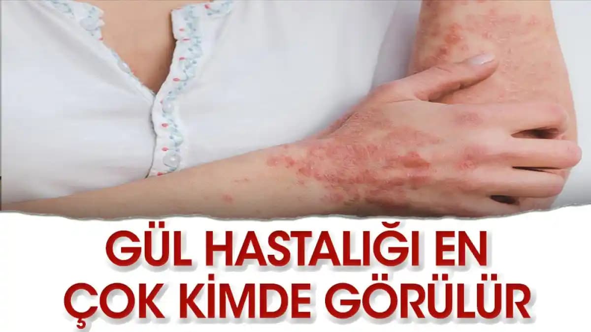 Elde Gül Hastalığı: Belirtileri, Nedenleri ve Etkili Bakım Yöntemleri