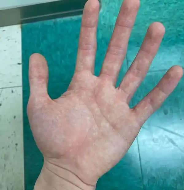 Elde Kızarıklık Nedenleri ve Kozmetik Çözüm Yolları Hakkında Bilmeniz Gerekenler