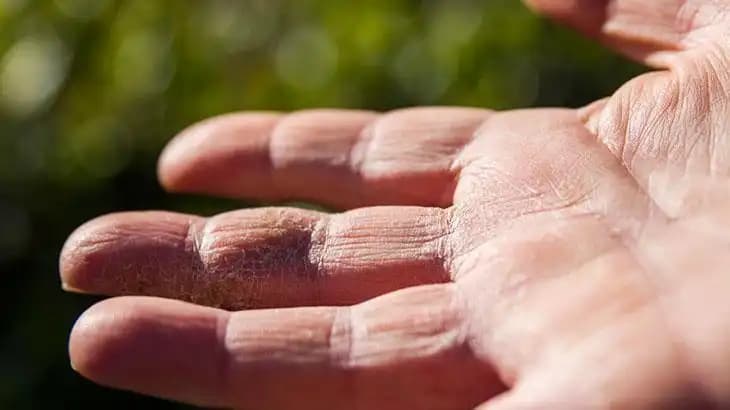 Elde Kuruluk Nedenleri ve Etkili Çözüm Yolları Günlük Bakımda Nelere Dikkat Edilmeli