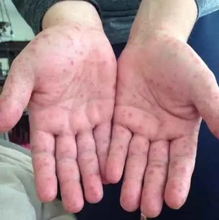 Elde Sivilce Sorunu ve Çözüm Yolları: Nedenleri ve Etkili Bakım Tavsiyeleri