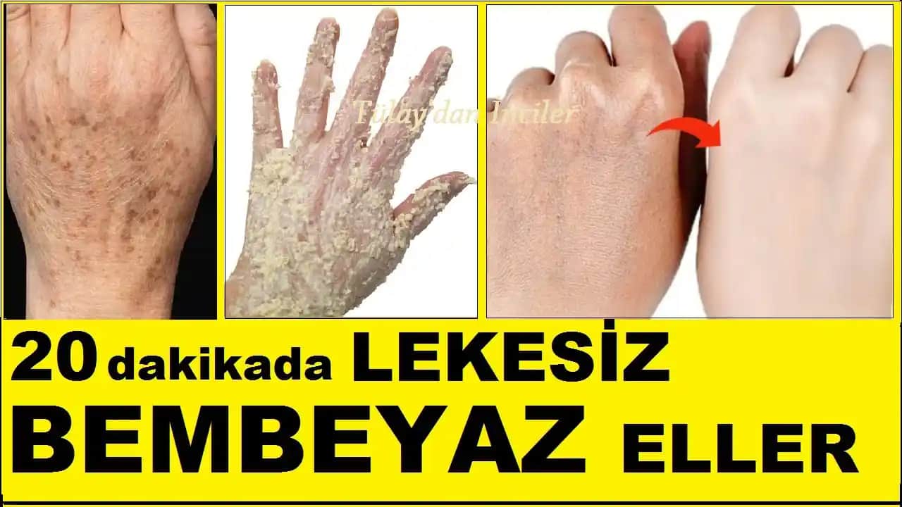 Eldeki Lekelerin Nedenleri ve Kozmetik Yaklaşımlarla Giderilme Yöntemleri