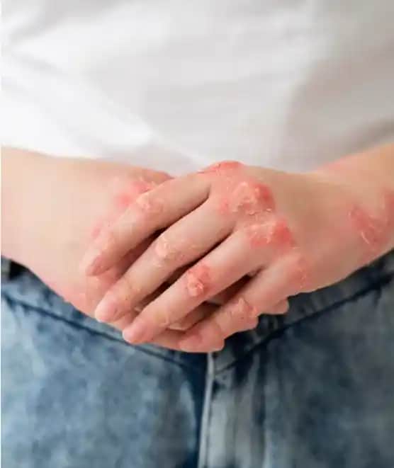 Ellerinizdeki Egzama Nedenleri, Belirtileri ve Etkili Bakım Yöntemleri