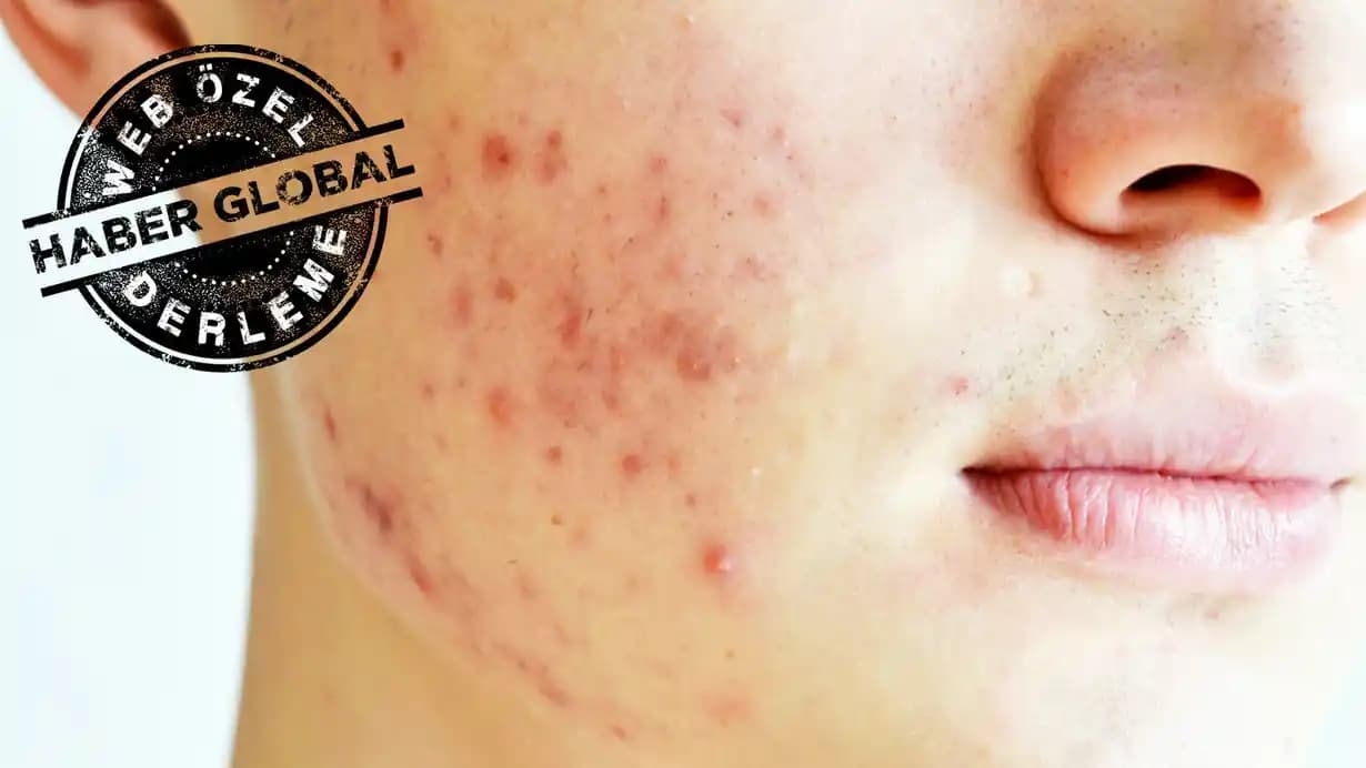 Ergenlikte Sivilce ve Cilt Sağlığı İçin Kozmetik Kullanımı Rehberi