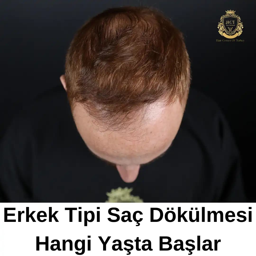 Erkeklerde Saç Dökülmesi Ne Zaman Başlar ve Etkili Önleme Yöntemleri Nelerdir?