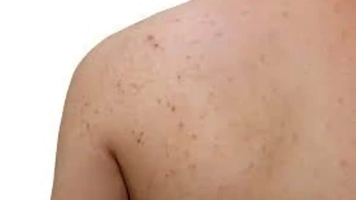 Erkeklerde Sırt Sivilcesinin Nedenleri ve Etkili Önleme Yöntemleri