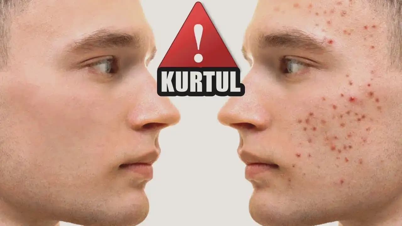 Erkeklerde Sivilce Ne Zaman Biter ve Cilt Sağlığını Koruma Yöntemleri