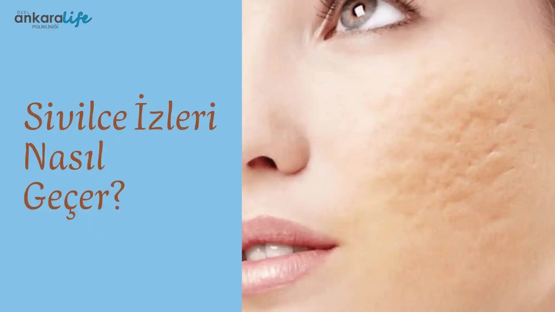 Eski Sivilce İzleri Nasıl Geçer Cilt Sağlığı ve Güzelliğin Anahtarı