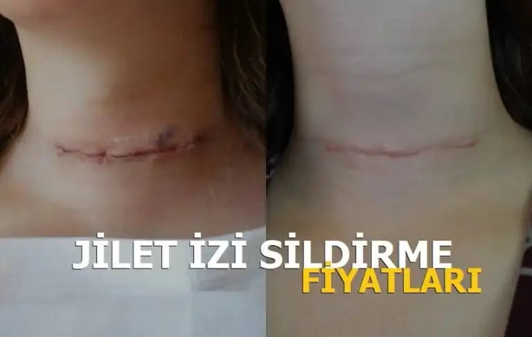 Evde Jilet İzi Giderme Yöntemleri: Doğal ve Güvenilir Cilt Yenileme Teknikleri