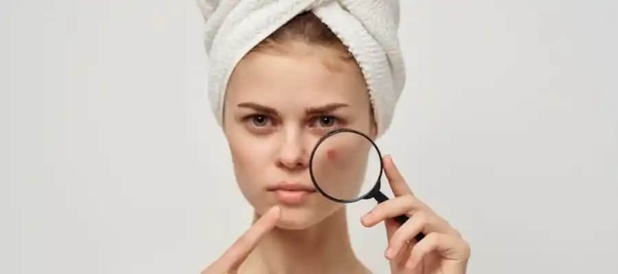 Fungal Akne Nedir, Belirtileri ve Doğru Tanı ile Etkili Tedavi Yöntemleri