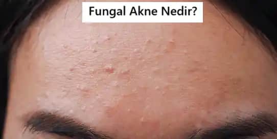 Fungal Akne Nedir, Belirtileri ve Etkili Tedavi Yöntemleri Hakkında Kapsamlı Rehber