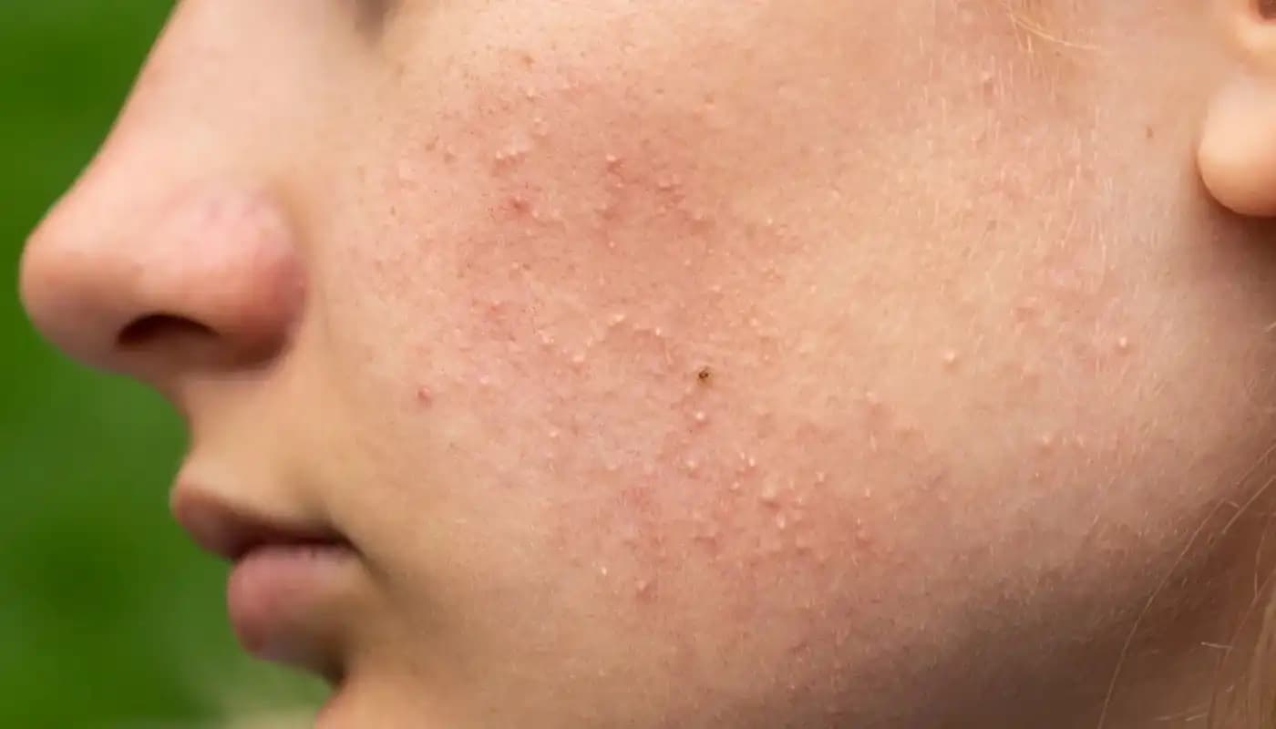 Fungal Akne Nedir ve Cilt Sağlığını Koruma Yöntemleri