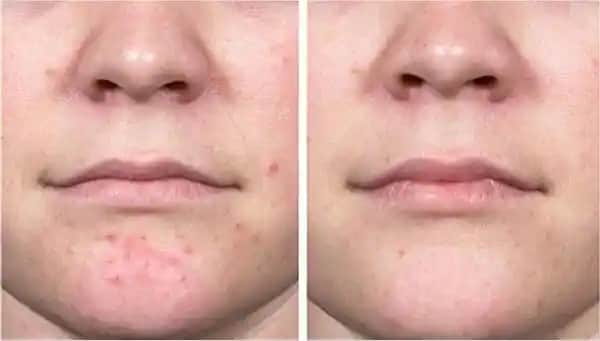 Geçmeyen Kistik Sivilce Nedenleri, Tedavi Yöntemleri ve Cilt Sağlığı İpuçları