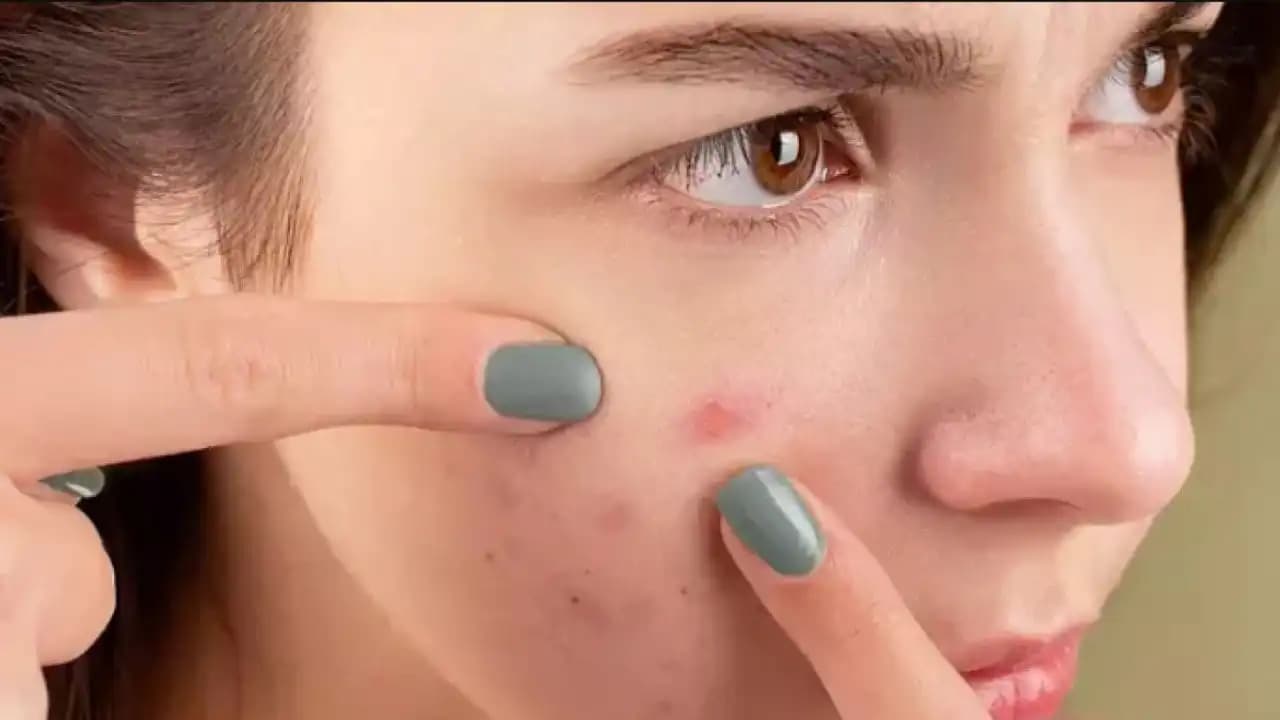 Geçmeyen Sivilce Nedenleri ve Çözüm Yolları Hakkında Detaylı Bilgi
