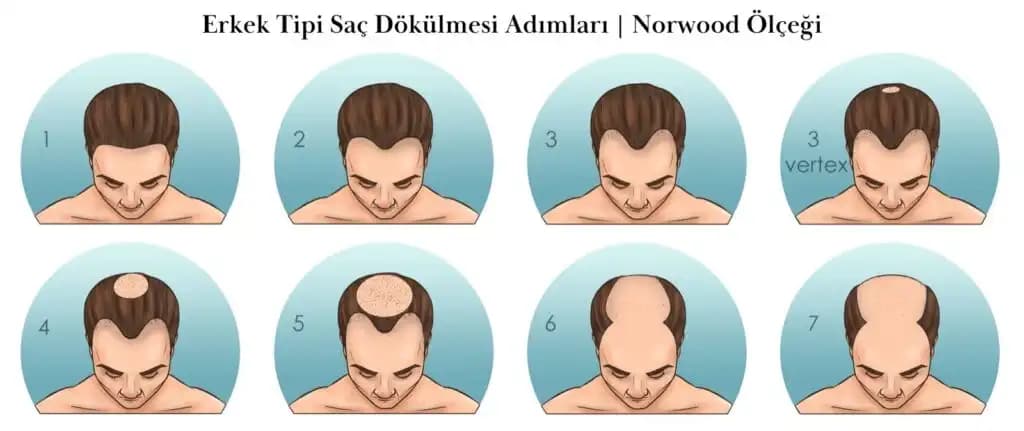 Genç Erkeklerde Saç Dökülmesinin Nedenleri ve Etkili Önlemler