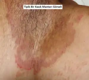 Genital Bölgedeki Egzama: Belirtiler, Tedavi ve Kozmetik İpuçları