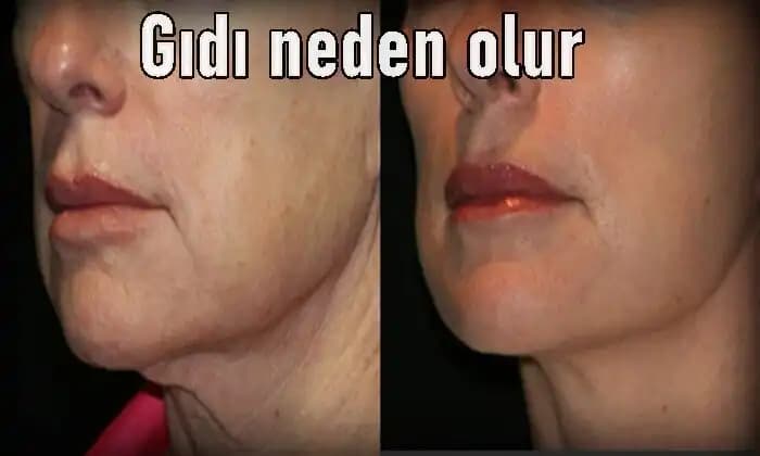 Gıdı Neden Oluşur ve Estetik ile Sağlık Açısından Çözüm Yöntemleri
