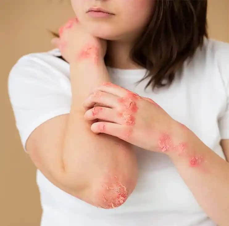 Göğüsler Arasındaki Egzama: Belirtileri, Nedenleri ve Etkili Bakım Yöntemleri
