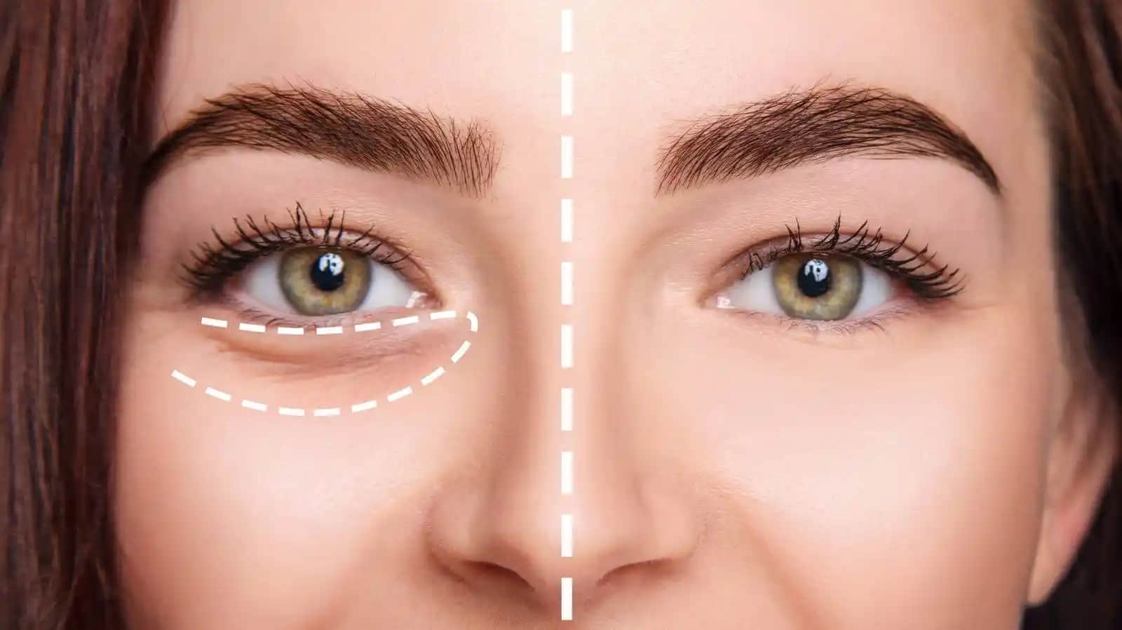 Göz Altı Bakımı Rehberi: Koyu Halkalar ve Şişliklerle Mücadelede Etkili Yöntemler