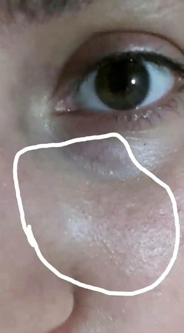 Göz Altı Beyaz Noktaları Nedenleri ve Etkili Tedavi Yöntemleri Hakkında Kapsamlı Rehber