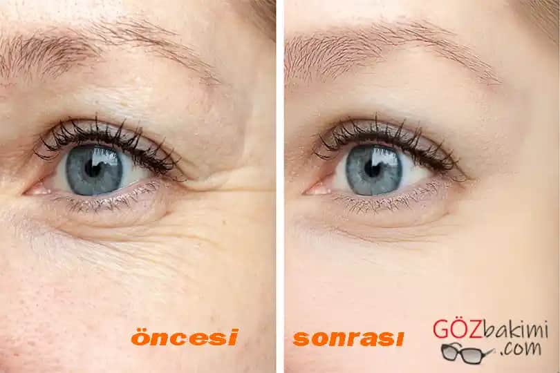 Göz Altı İnce Çizgilerine Karşı Etkili Çözüm Yöntemleri ve Bakım İpuçları