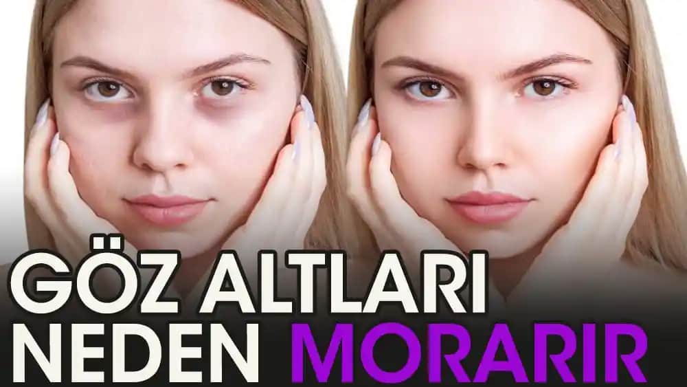 Göz Altı Morarmalarının Nedenleri ve Etkili Çözüm Yöntemleri Hakkında Detaylı Bilgi