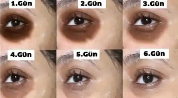 Göz Altı Morarması ve Vitamin Eksiklikleri: Sağlıklı Gözler İçin Bilmeniz Gerekenler