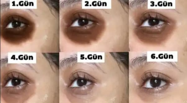 Göz Altı Morarması ve Vitamin Eksiklikleri: Sağlıklı Gözler İçin Bilmeniz Gerekenler