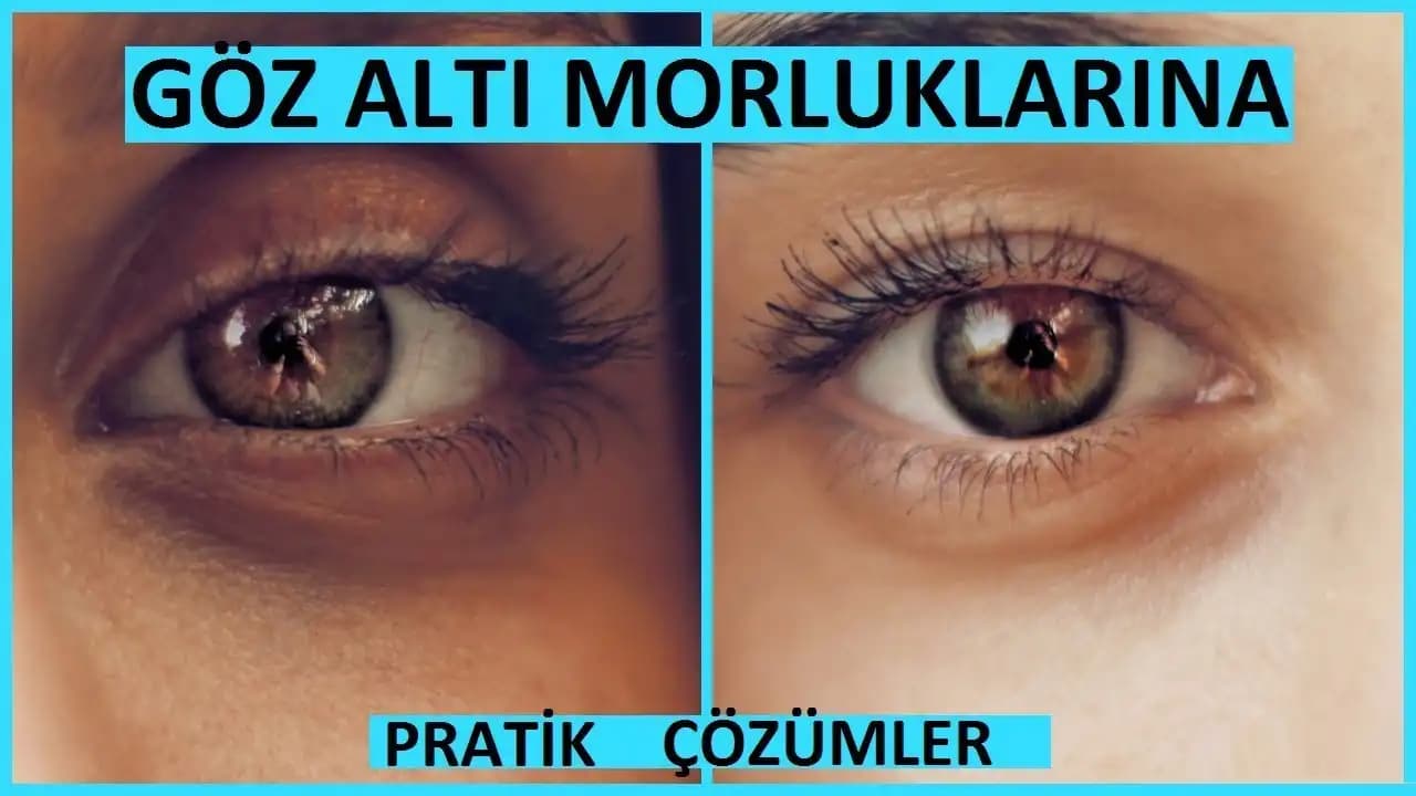Göz Altı Morluklarının Nedenleri ve Çözüm Yolları: Sağlıklı ve Işıltılı Bir Görünüm İçin Rehber