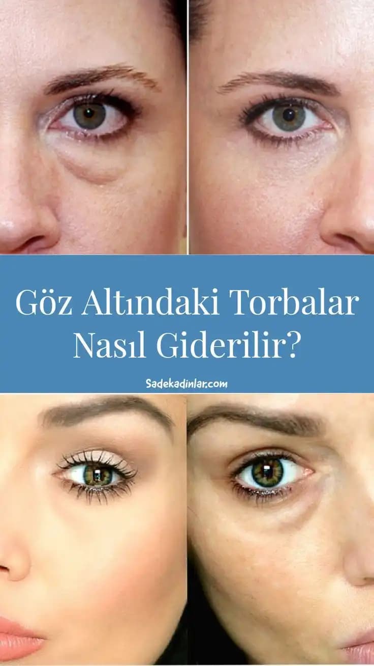 Göz Altı Morluklarının Nedenleri ve Etkili Çözüm Yöntemleri Hakkında Kapsamlı Bilgi