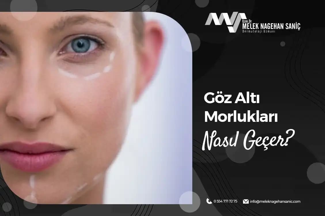 Göz Altı Morluklarıyla Mücadele Yöntemleri ve Uzman Tavsiyeleri
