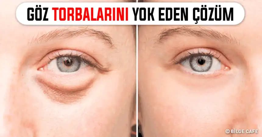 Göz Altı Torbalarına Karşı Etkili Çözüm Yöntemleri ve Bakım Tavsiyeleri