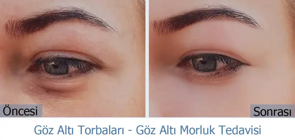 Göz Altı Torbalarıyla Mücadelede Güncel ve Etkili Yöntemler